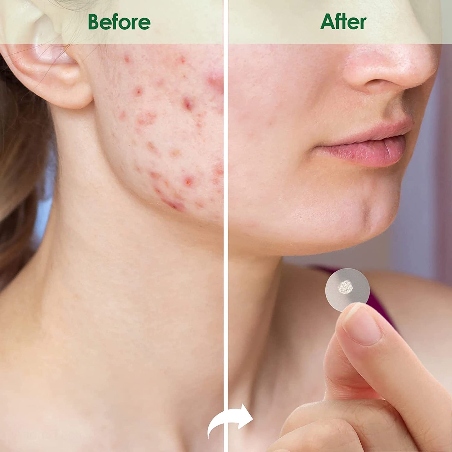 Tea Tree Oil Acne Pimple Patch 108PCS Absorb Hydrocolloid Spot Treat Heal Fast